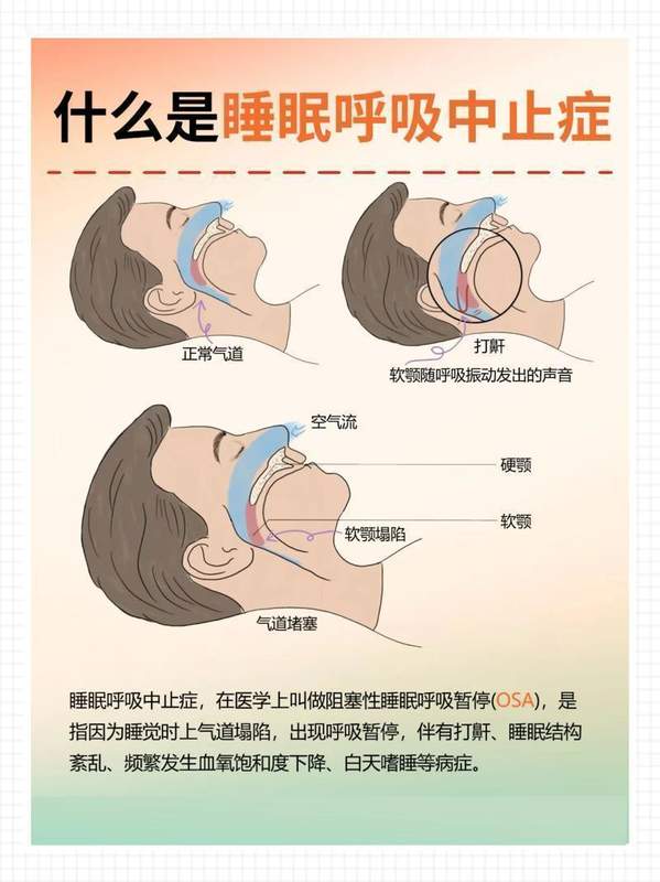 连续三次车祸后,他再不敢开车;检查结果震惊所有人:一夜呼吸中断数百次。 健康养生